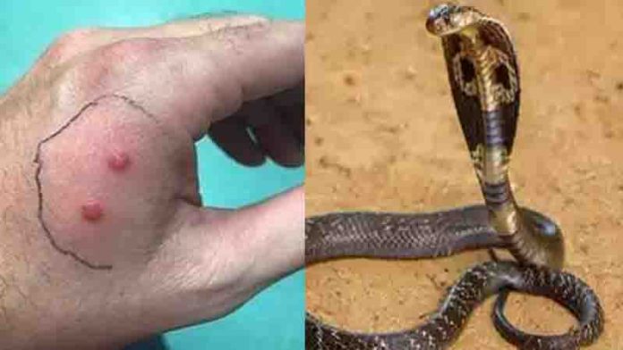 সাপের দংশনে বিষ মুক্ত হওয়া উপায়